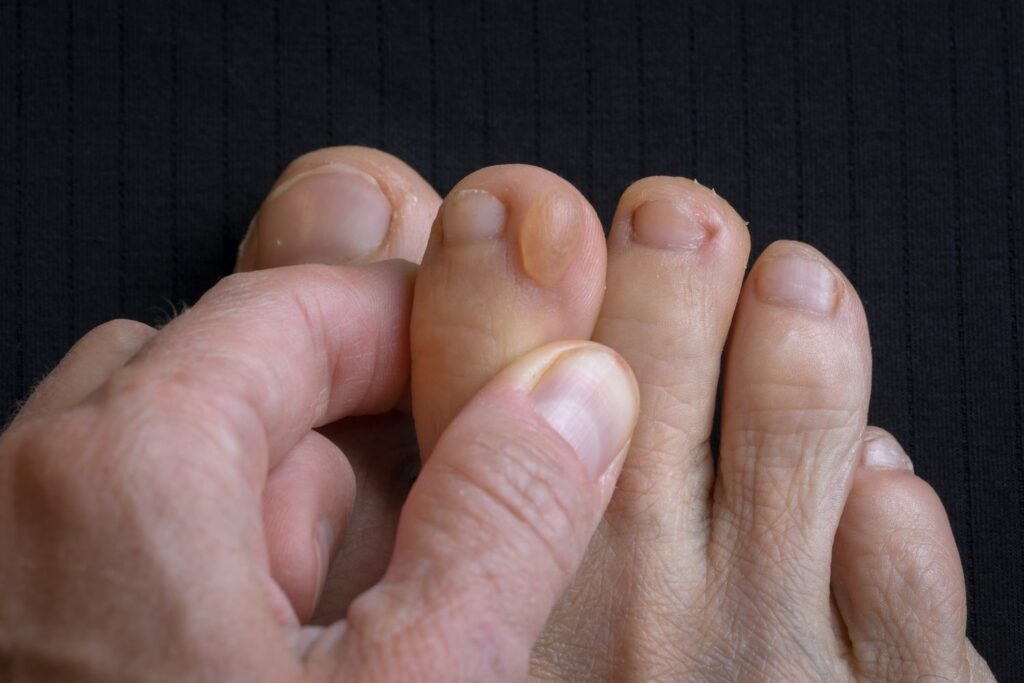 The Problem of Blisters